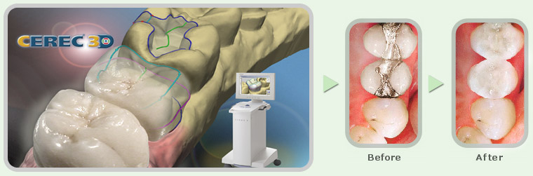 CEREC 3D