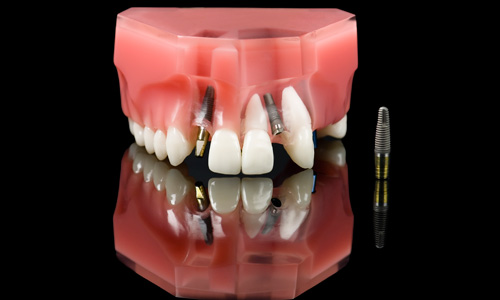 Dental implant example'