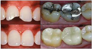 tooth restoration'