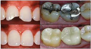 dental implants'