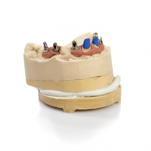 Dental implant model'