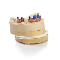 Dental implant model