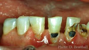 dental caries