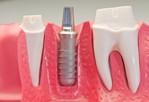Dental Implant illustration