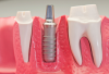 Dental Implant illustration'