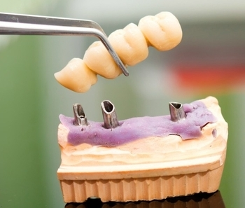 Dental implant model