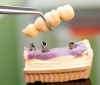 Dental implant model'