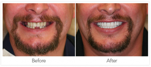 Dental Implant (Before &amp;amp; After)'