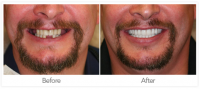 Dental Implant (Before &amp; After)