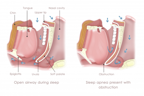 Obstruction sleep apnea'