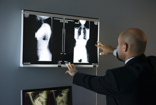 Scoliosis Surgery Los Angeles Offered by Top Spine Surgeon'