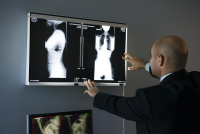 Scoliosis Surgery Los Angeles Offered by Top Spine Surgeon