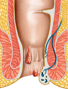 Thrombosed External Hemorrhoid'