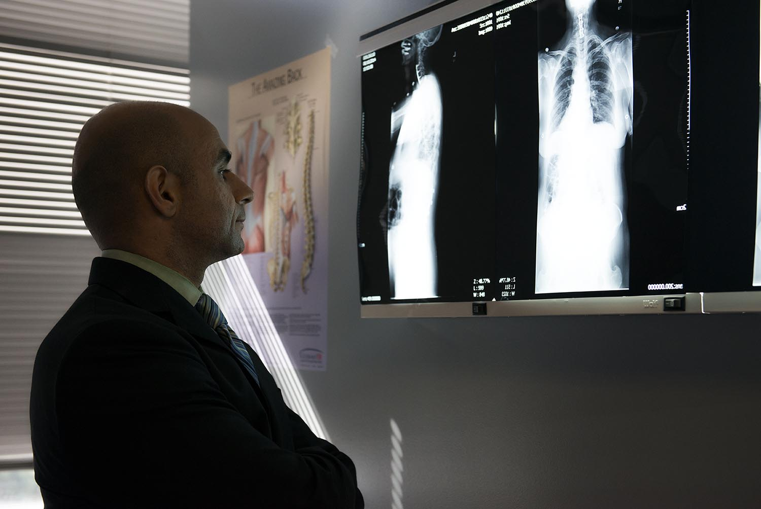 Thoracic Spine Surgery in Los Angeles