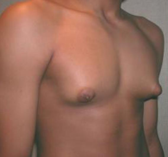How To Get Rid Of Gyno'