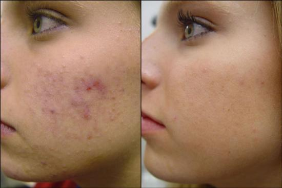 Acne Scar Cream Reviews