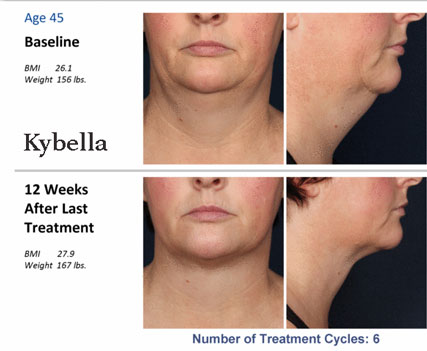 Kybella Before and After'