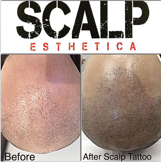 Scalp Micropigmentation
