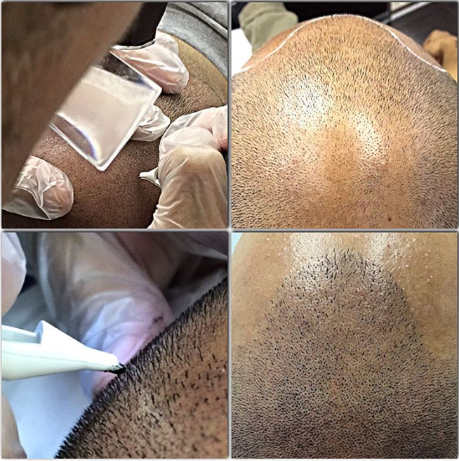 Scalp Esthetica Toronto: The Best SMP Clinic