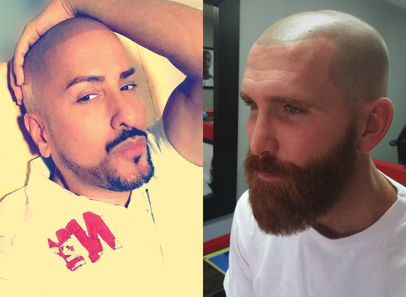 Best Scalp Micropigmentation in Toronto