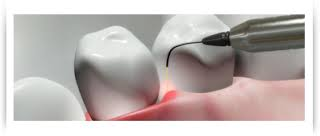 laser periodontal treatment'