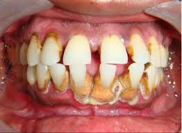 periodontal disease