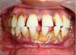 periodontal disease'