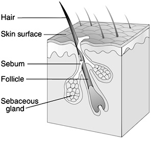 Acne Treatment'