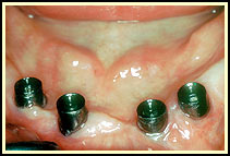 Implant Supported Dentures'