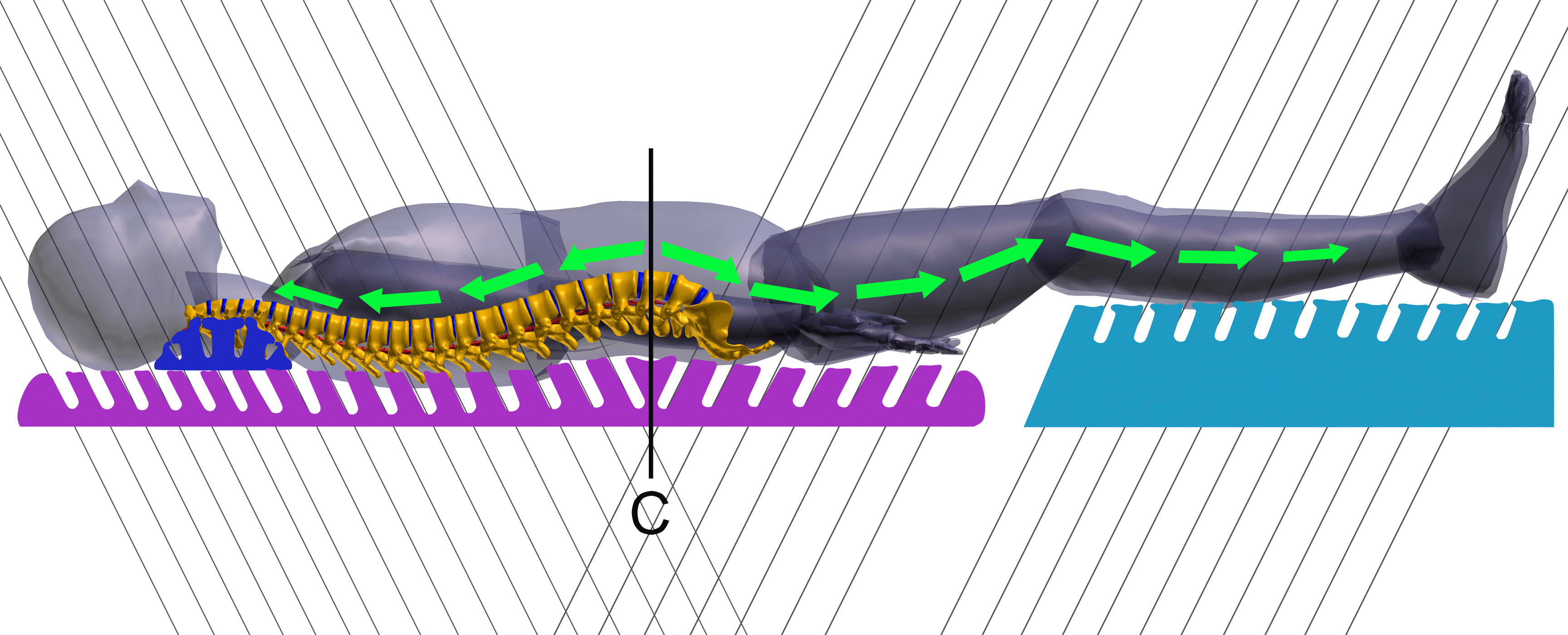 Spinal traction with Detensor is an easy procedure