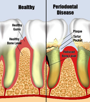 Gum disease'