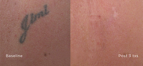 Sound Tattoo Removal